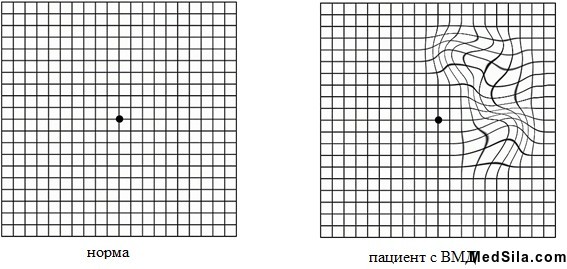 сетка амслера в норме и при ВМД