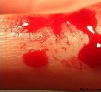 Кровотечение